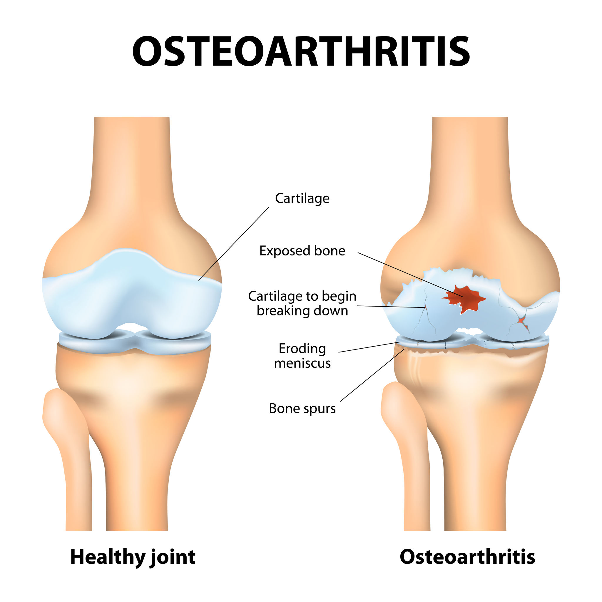 Collagen for bone and joint health